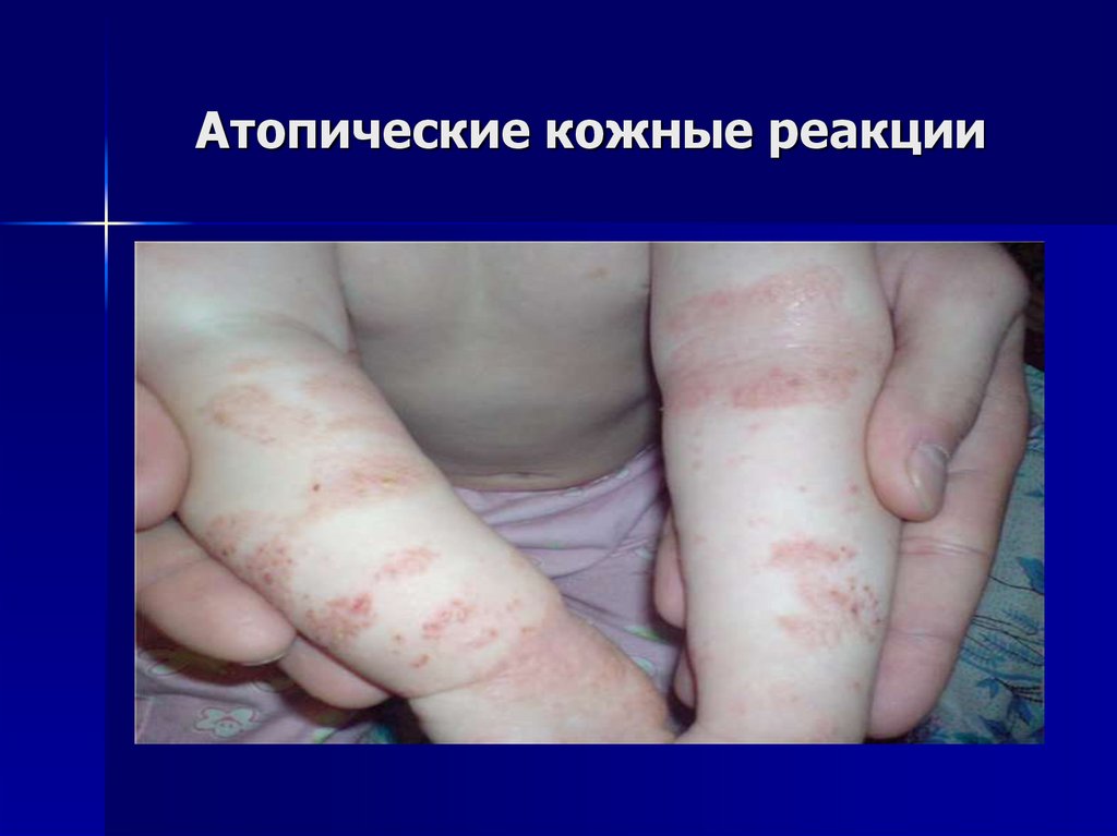 Атопические кожные реакции