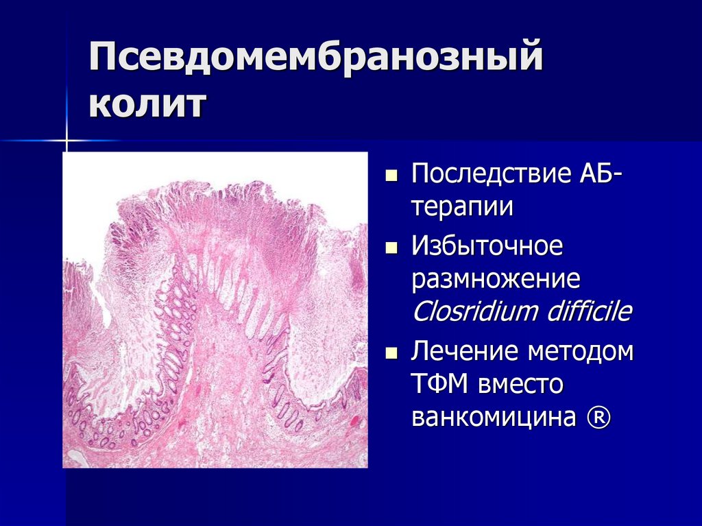 Псевдомембранозный колит