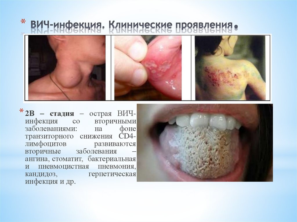 ВИЧ-инфекция. Клинические проявления.