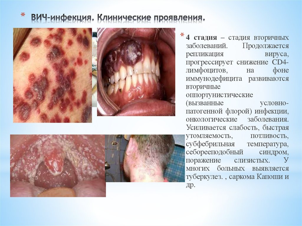 ВИЧ-инфекция. Клинические проявления.