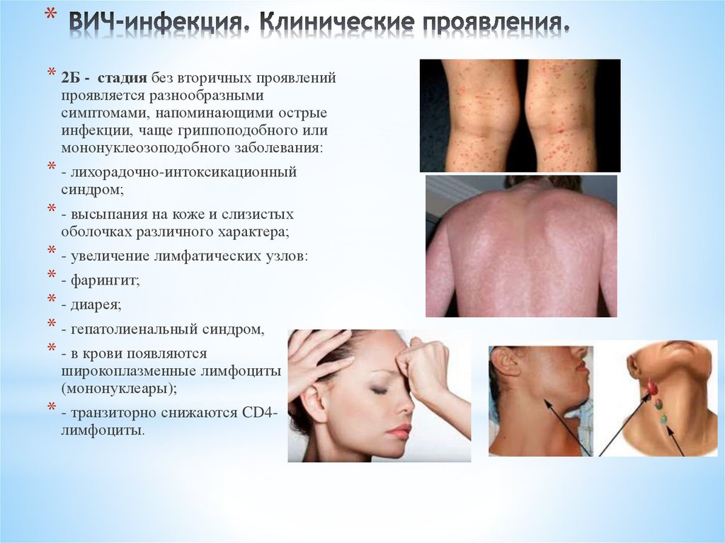 ВИЧ-инфекция. Клинические проявления.
