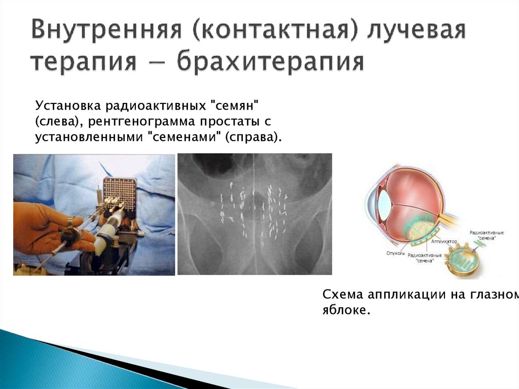 Внутренняя (контактная) лучевая терапия − брахитерапия