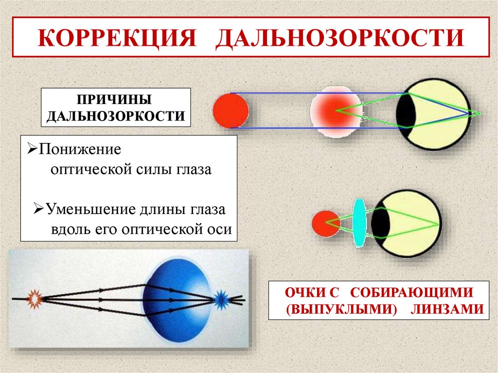 КОРРЕКЦИЯ БЛИЗОРУКОСТИ