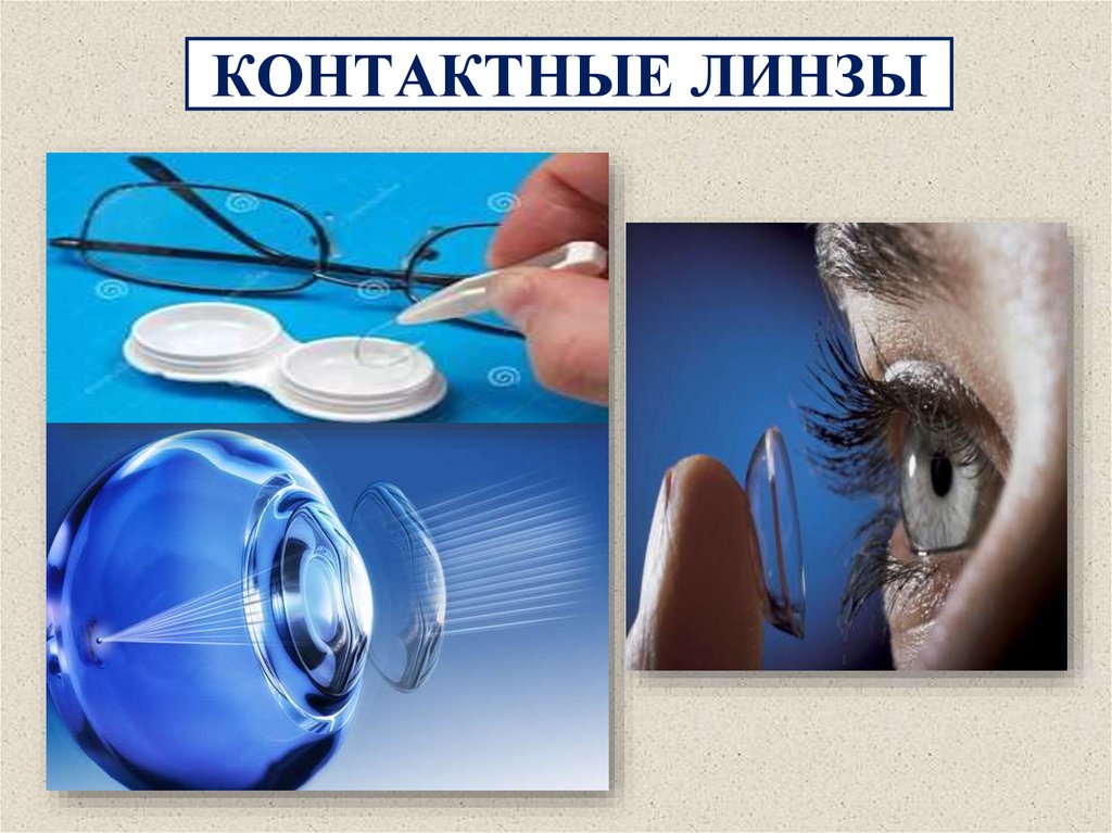 КОРРЕКЦИЯ ДАЛЬНОЗОРКОСТИ