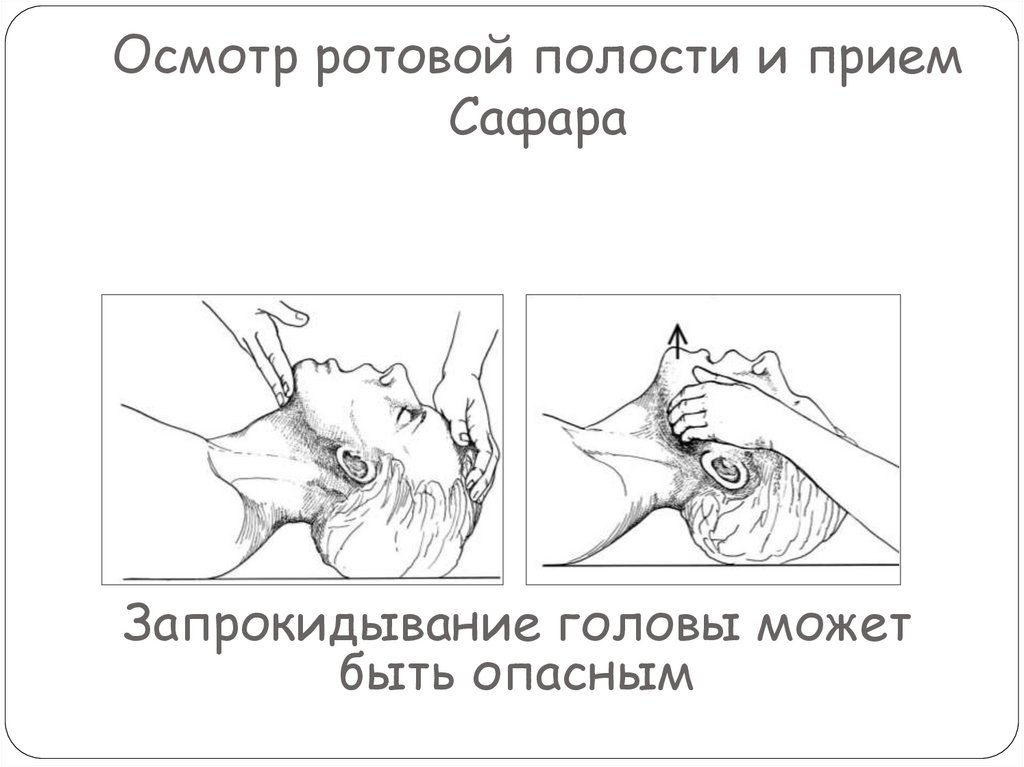 Осмотр ротовой полости и прием Сафара