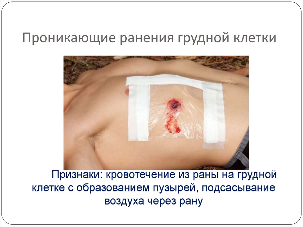 Проникающие ранения грудной клетки