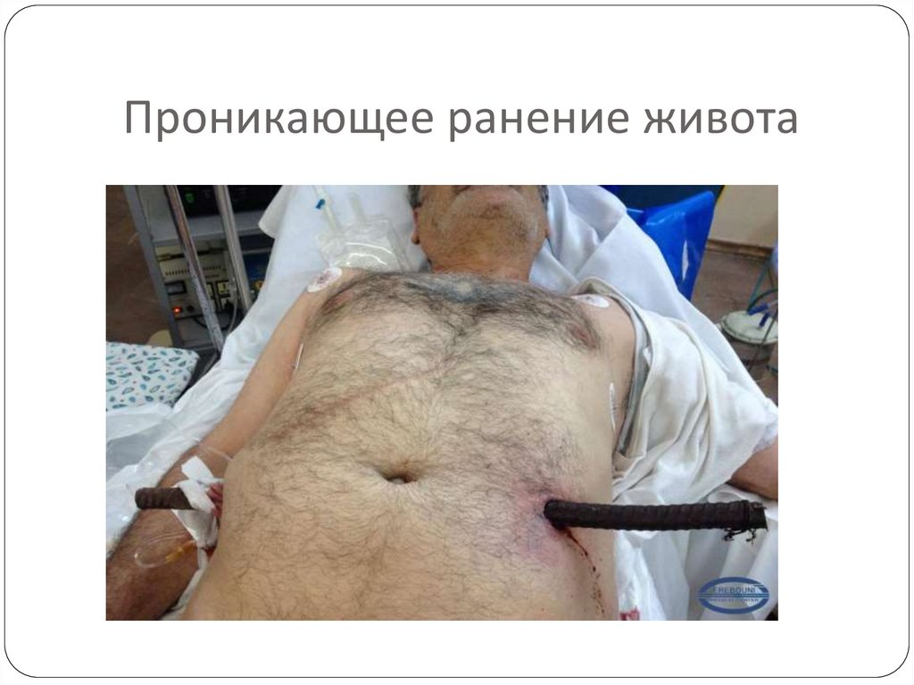 Проникающее ранение живота