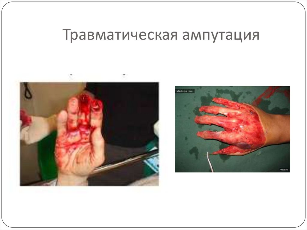Травматическая ампутация