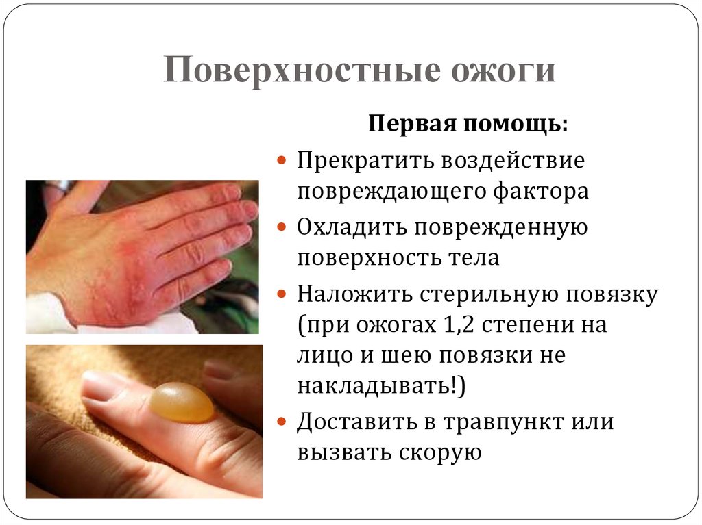 Поверхностные ожоги