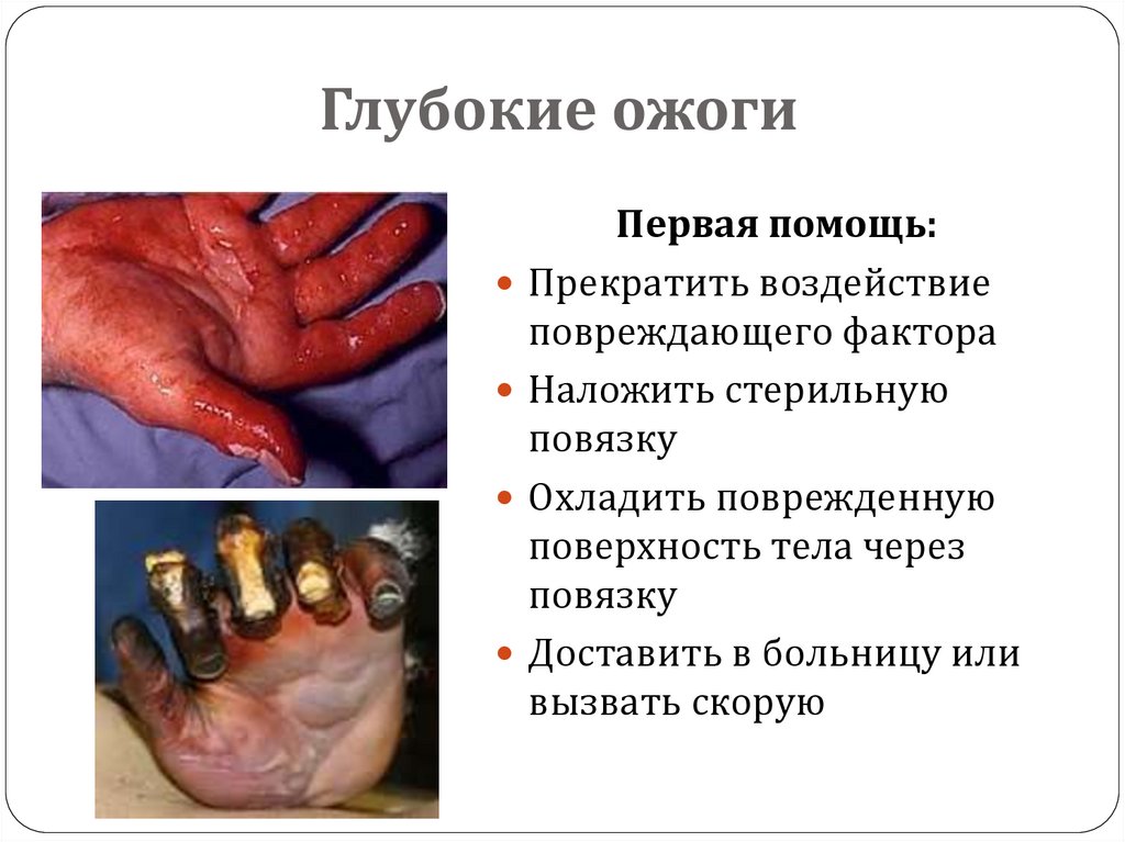 Глубокие ожоги