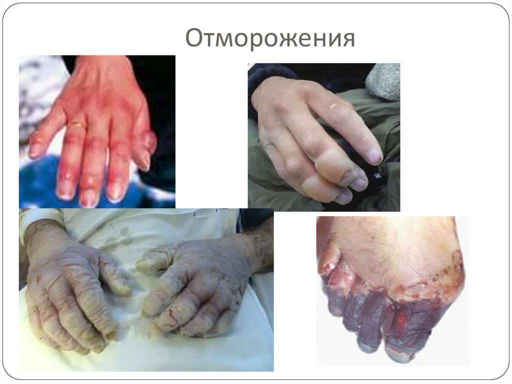 Отморожения