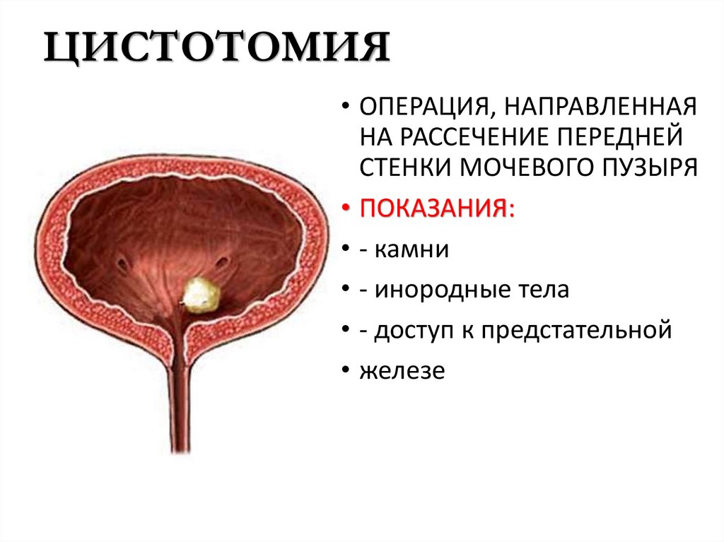 ЦИСТОТОМИЯ