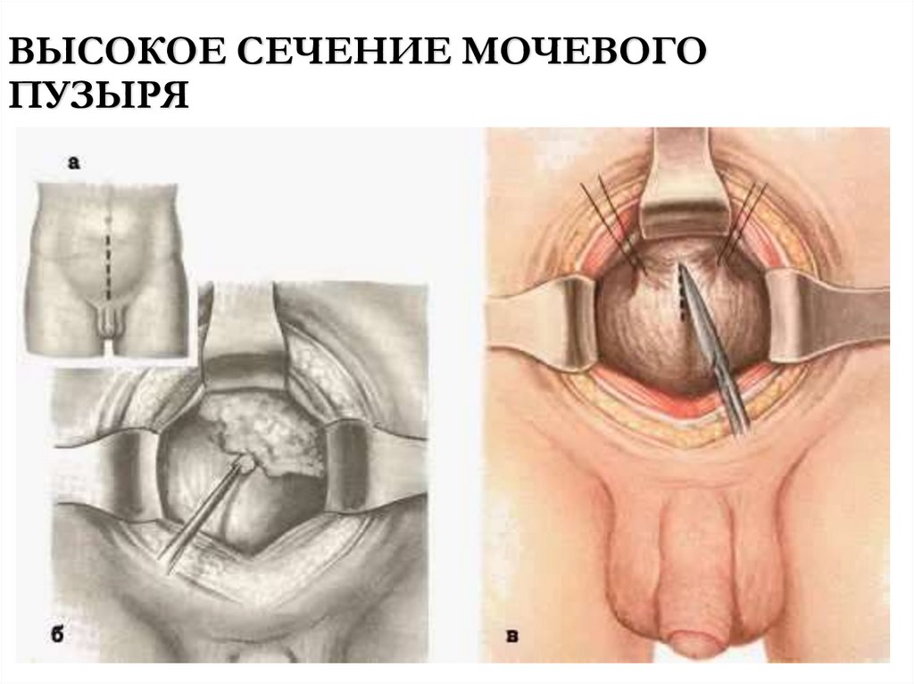 ВЫСОКОЕ СЕЧЕНИЕ МОЧЕВОГО ПУЗЫРЯ