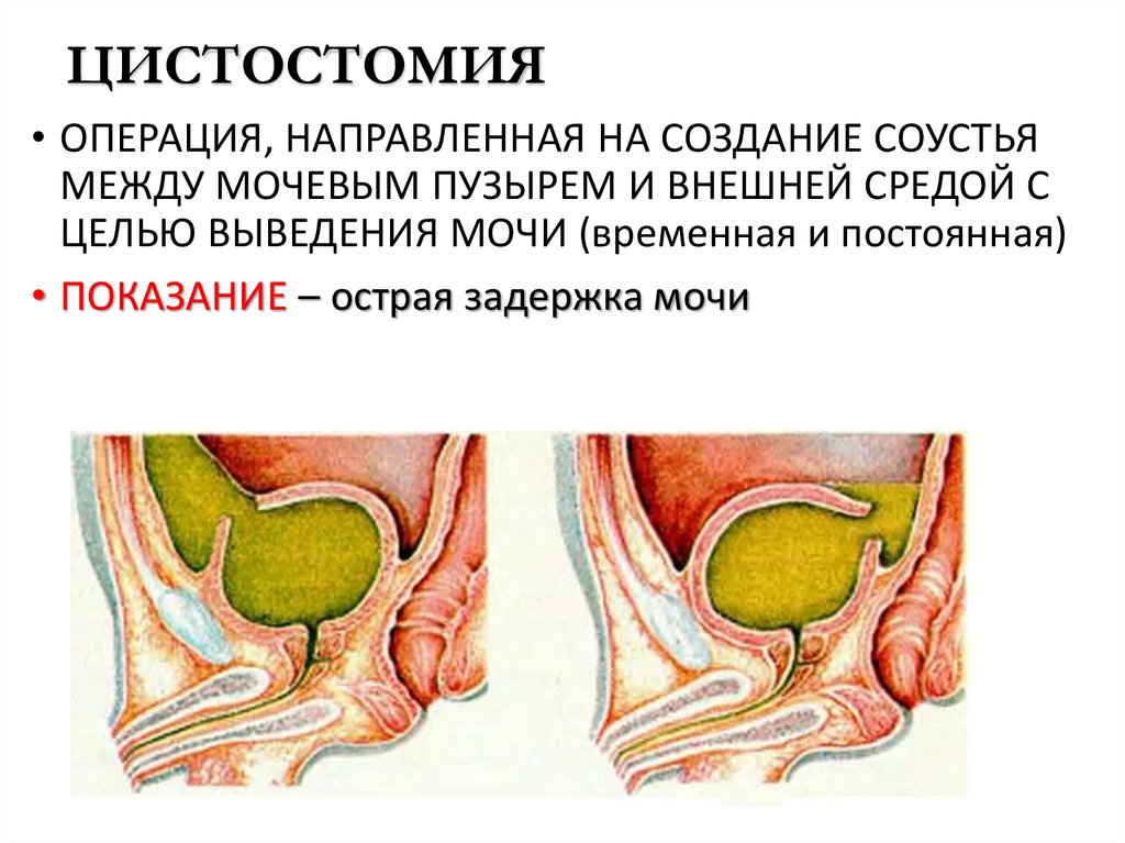 ЦИСТОСТОМИЯ