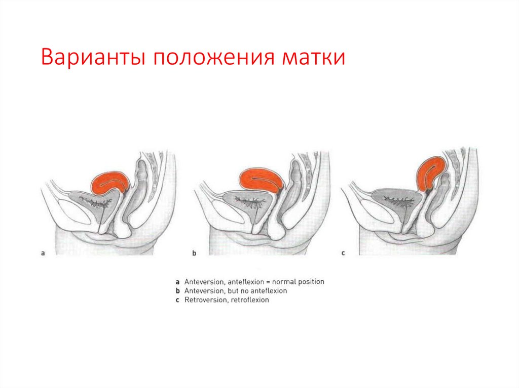 Варианты положения матки