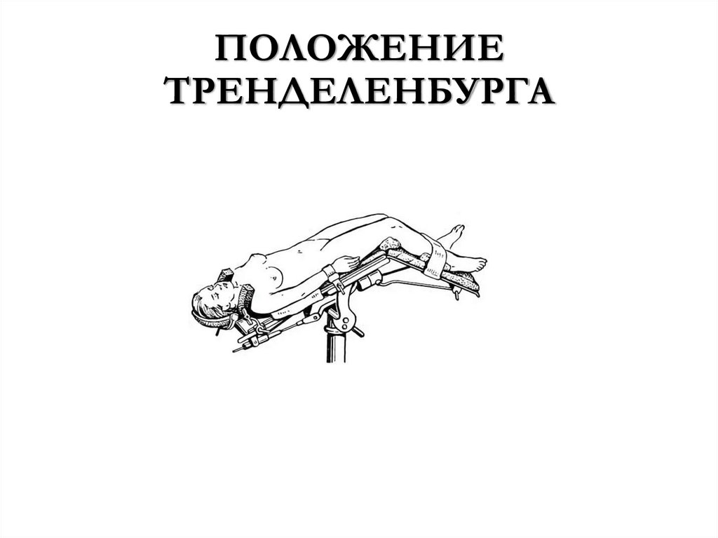 ПОЛОЖЕНИЕ ТРЕНДЕЛЕНБУРГА