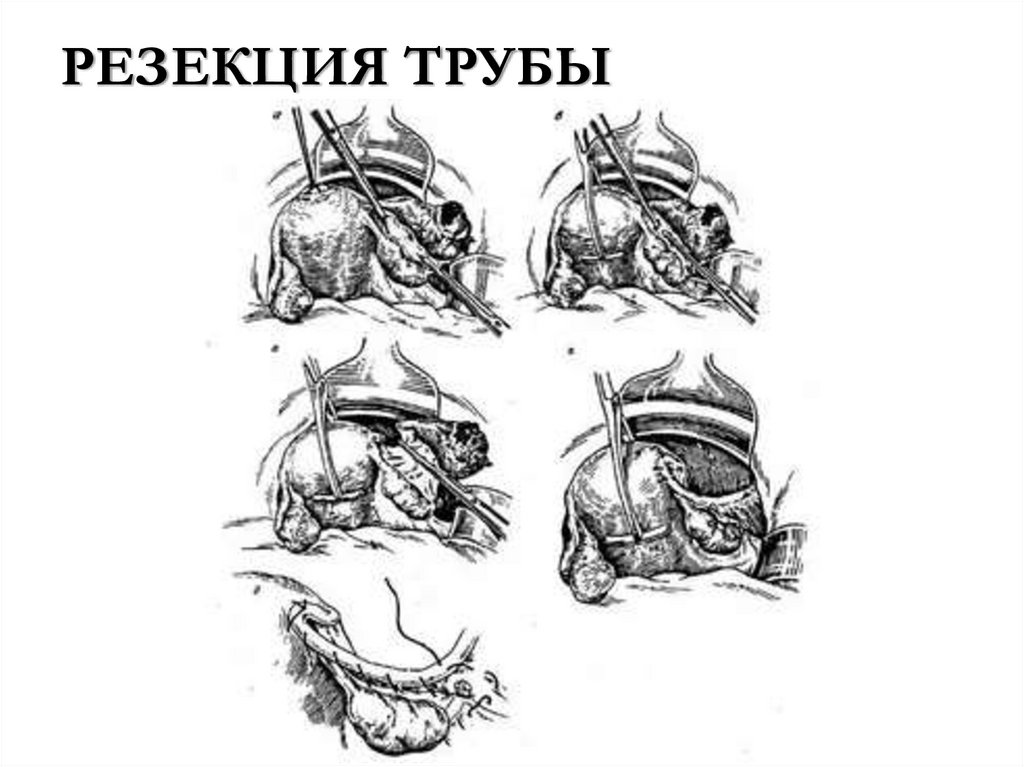 РЕЗЕКЦИЯ ТРУБЫ