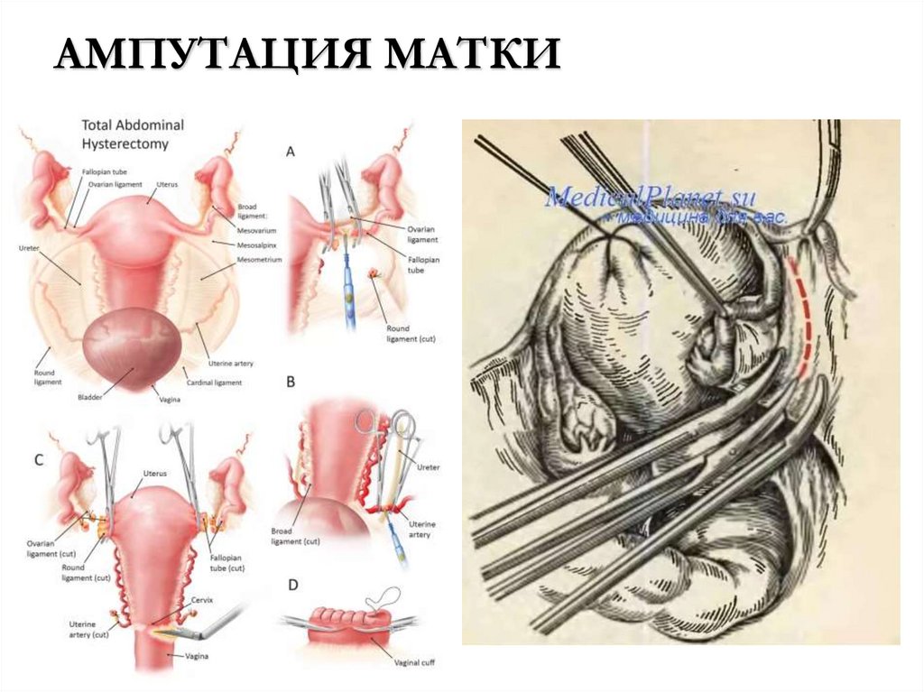 АМПУТАЦИЯ МАТКИ