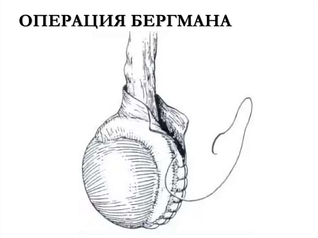 ОПЕРАЦИЯ БЕРГМАНА