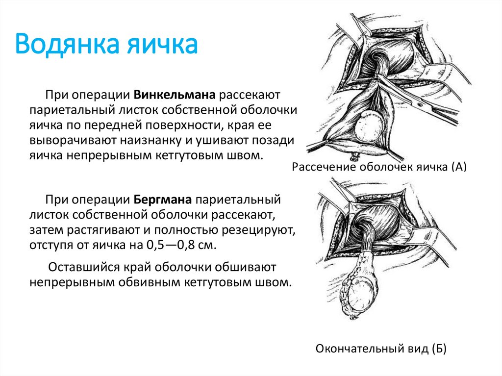 Водянка яичка