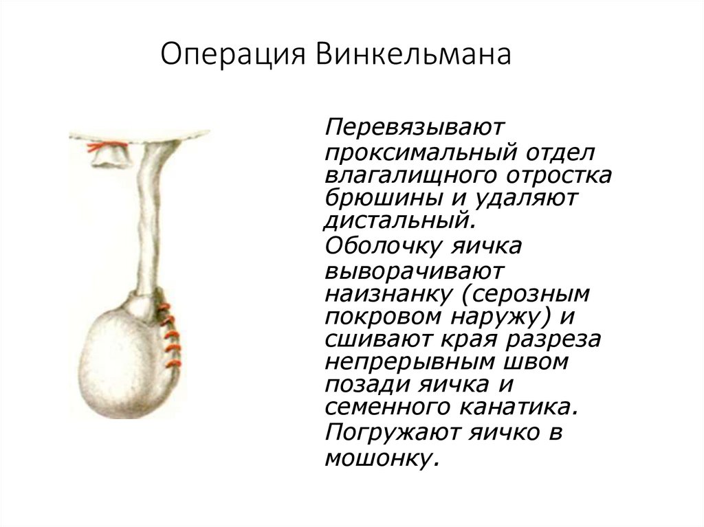 Операция Винкельмана