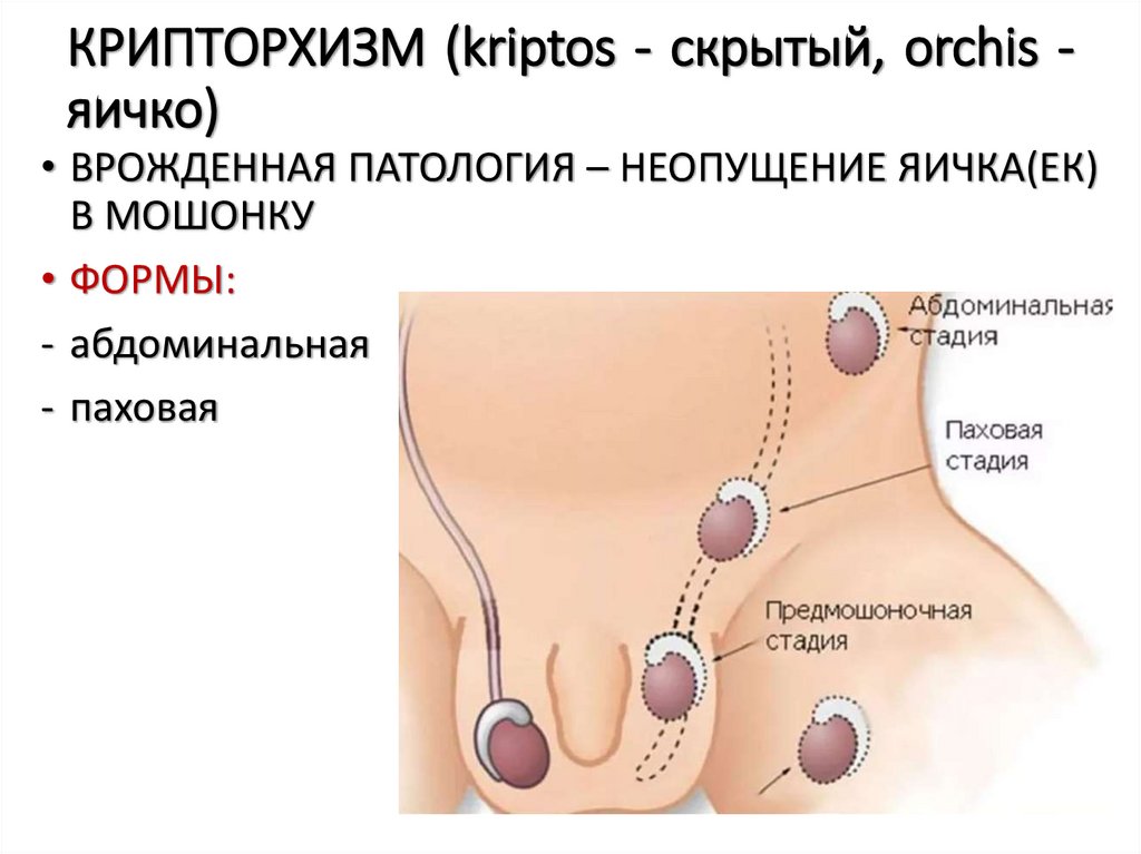 КРИПТОРХИЗМ (kriptos - скрытый, orchis - яичко)