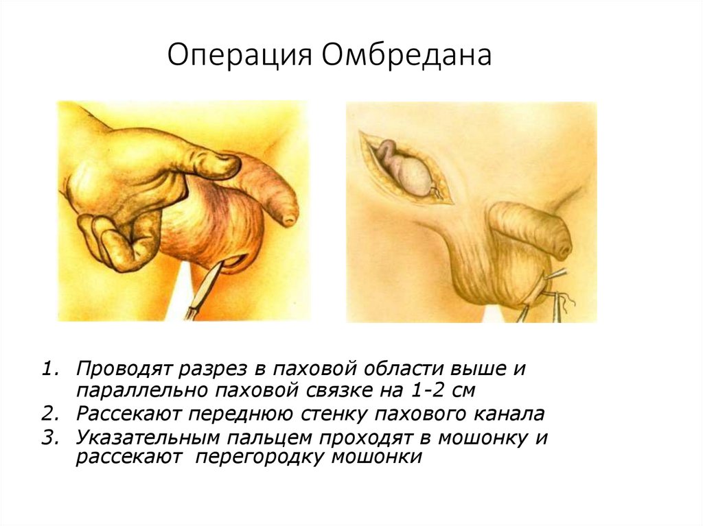 Операция Омбредана