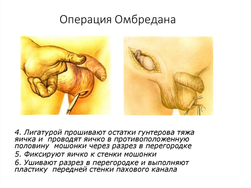 Операция Омбредана