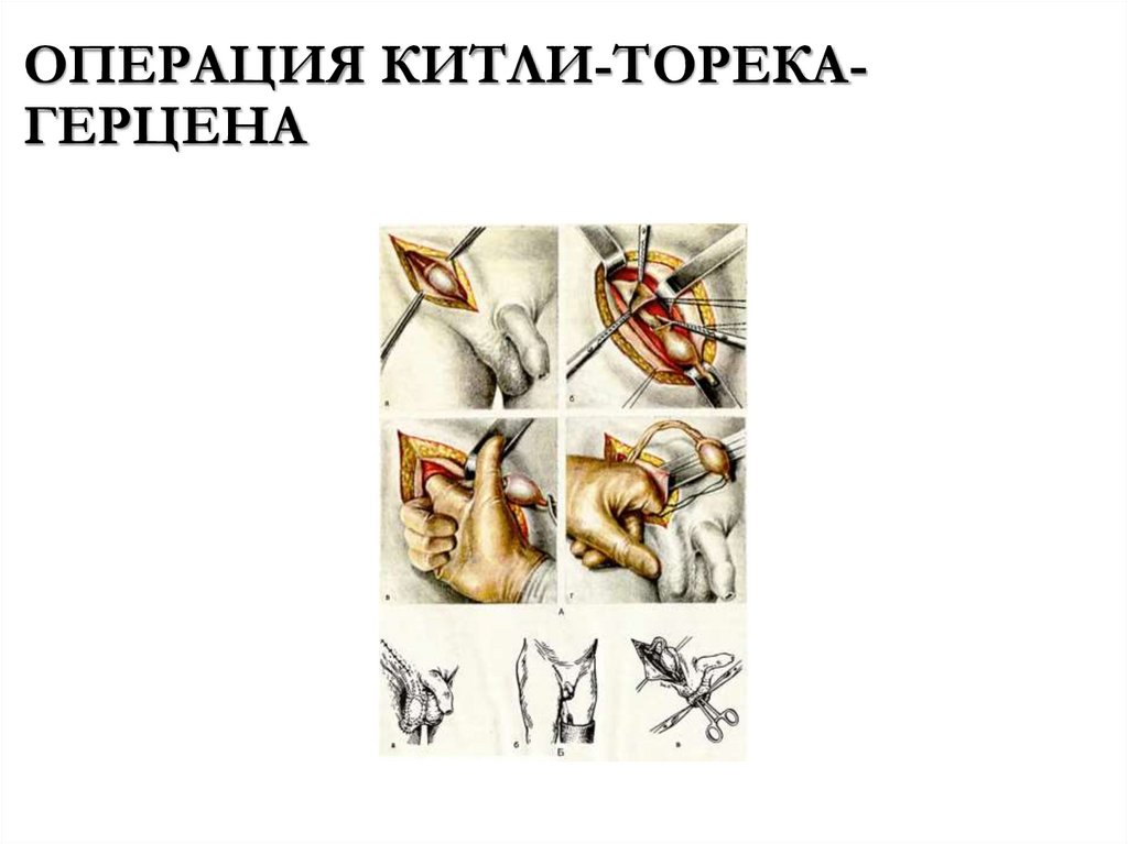 ОПЕРАЦИЯ КИТЛИ-ТОРЕКА-ГЕРЦЕНА