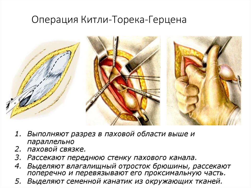 Операция Китли-Торека-Герцена