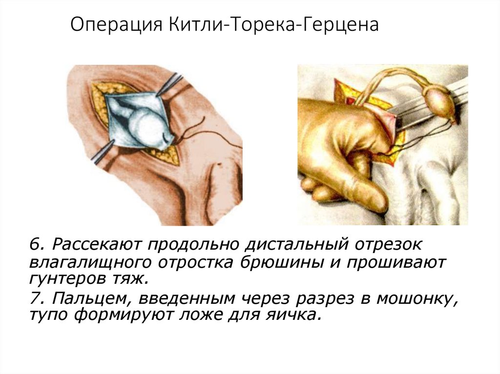 Операция Китли-Торека-Герцена