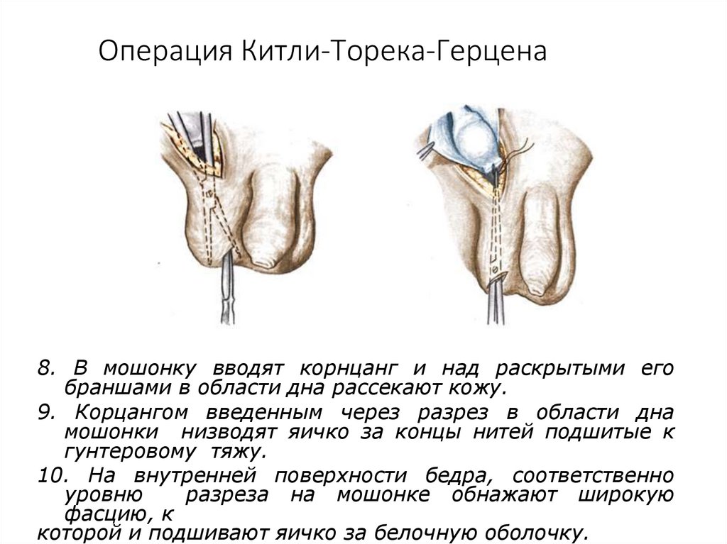 Операция Китли-Торека-Герцена