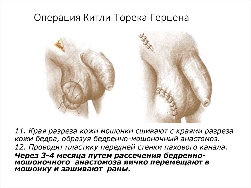 Операция Китли-Торека-Герцена