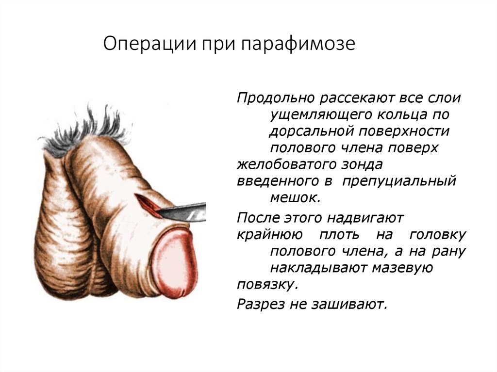 Операции при парафимозе