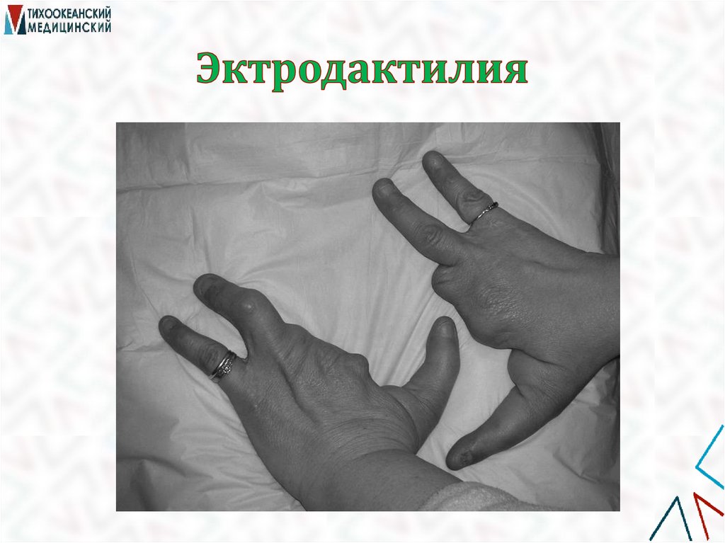 Эктродактилия