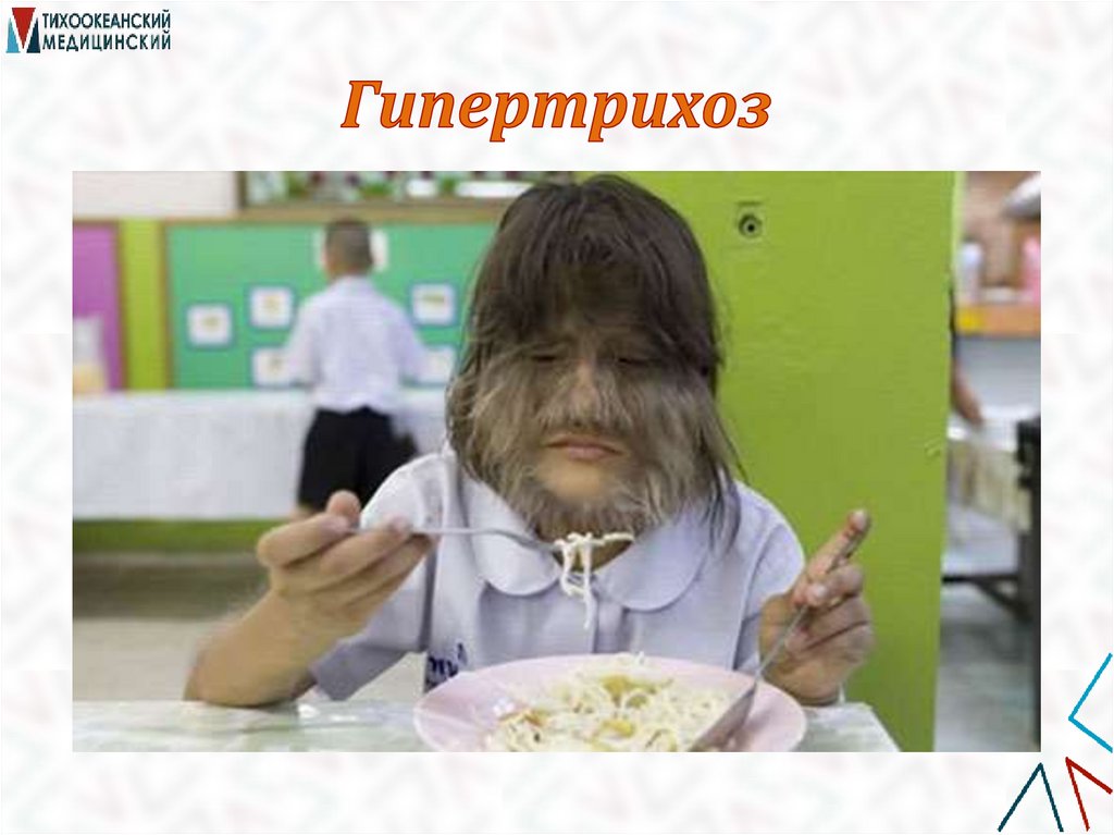 Гипертрихоз