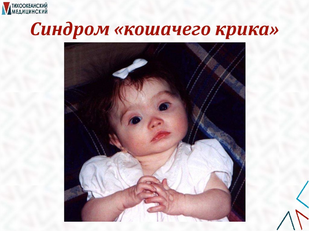 Синдром «кошачего крика»