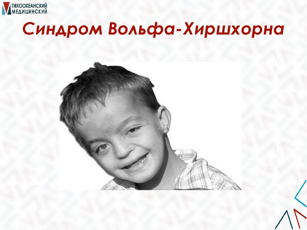 Синдром Вольфа-Хиршхорна