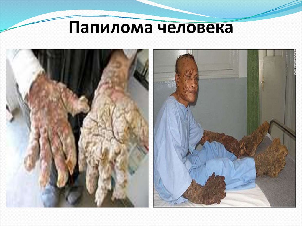 Папилома человека