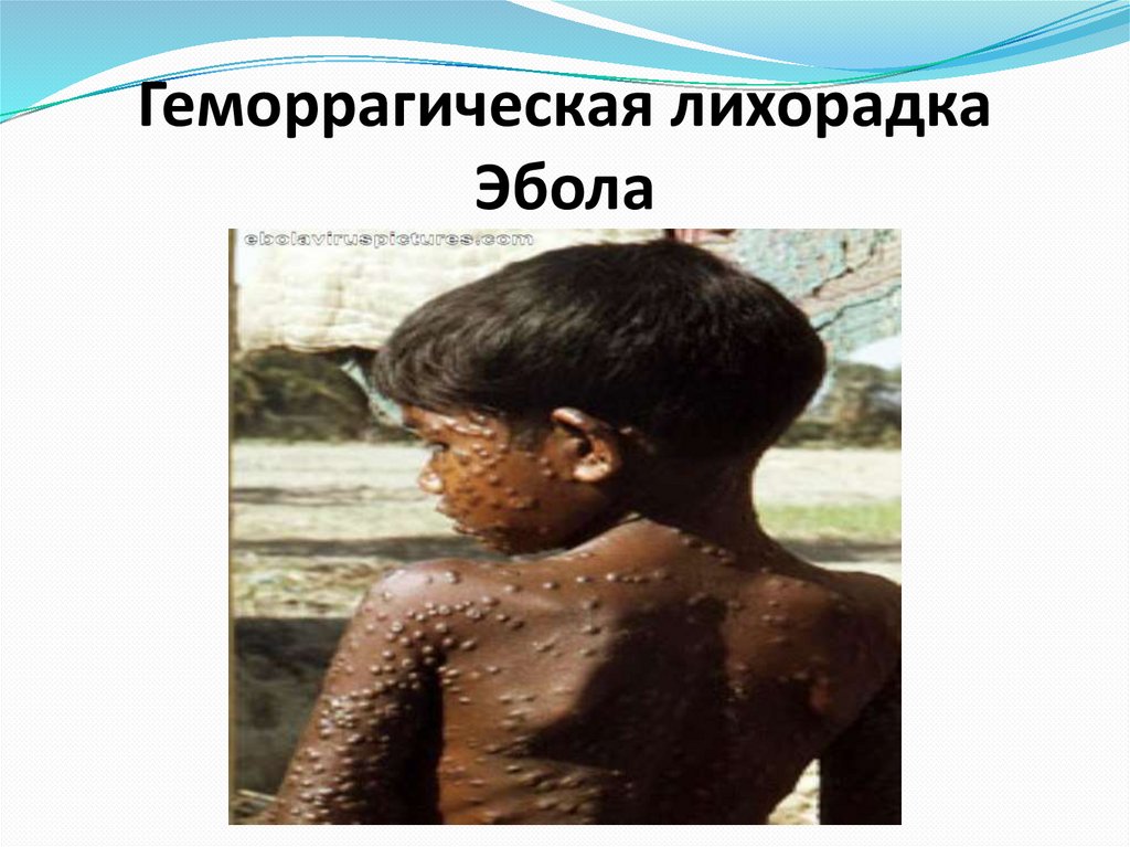 Геморрагическая лихорадка Эбола