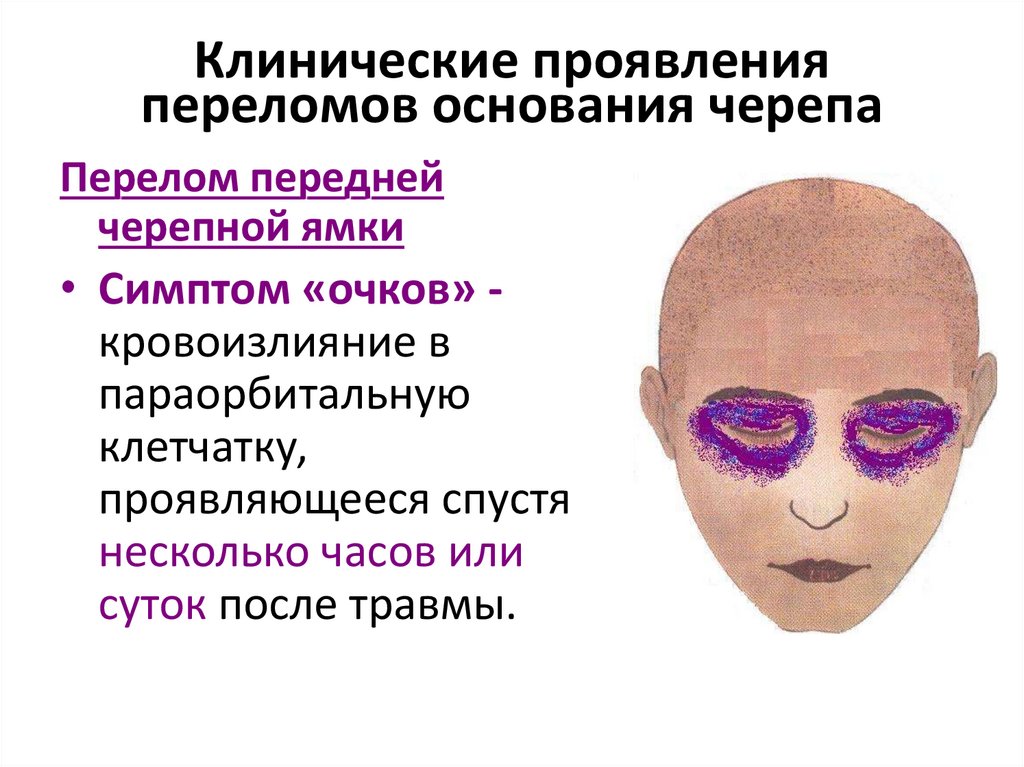 Клинические проявления переломов основания черепа