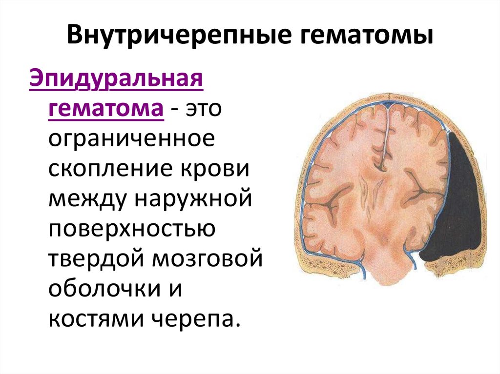 Внутричерепные гематомы
