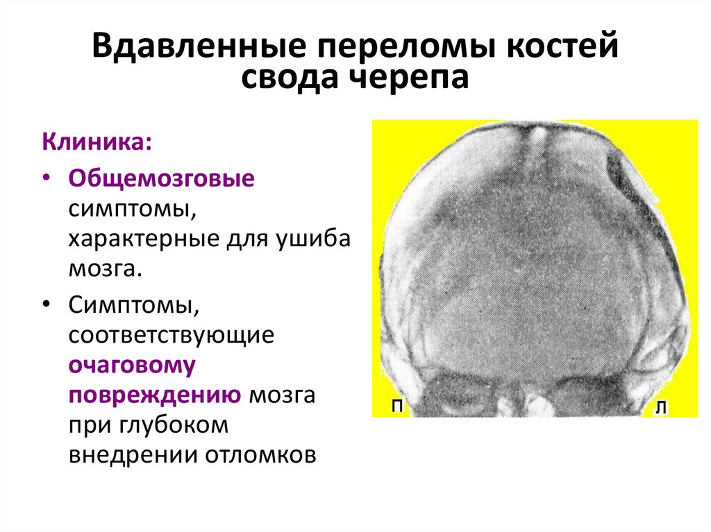 Вдавленные переломы костей свода черепа