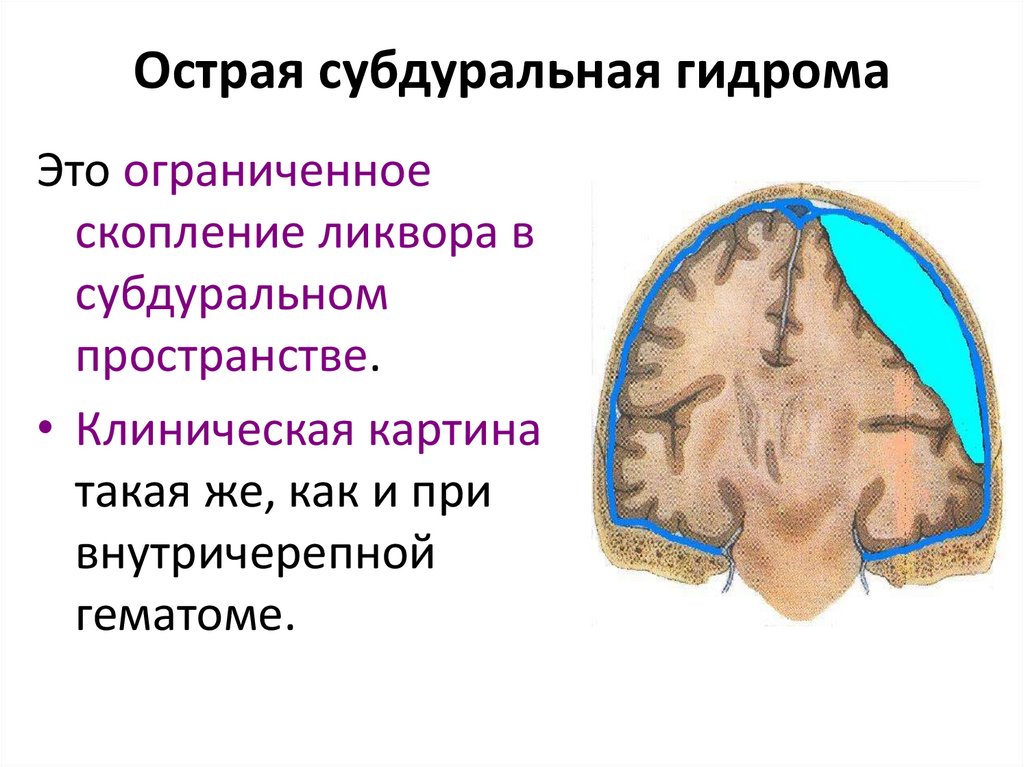 Острая субдуральная гидрома