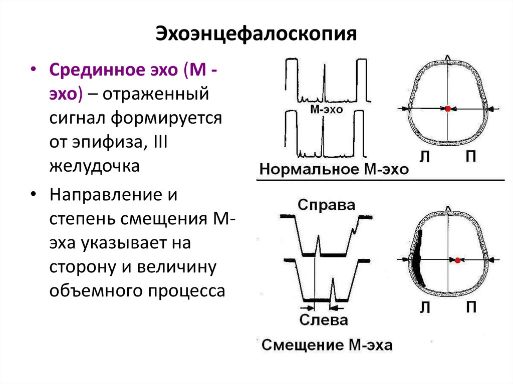 Эхоэнцефалоскопия
