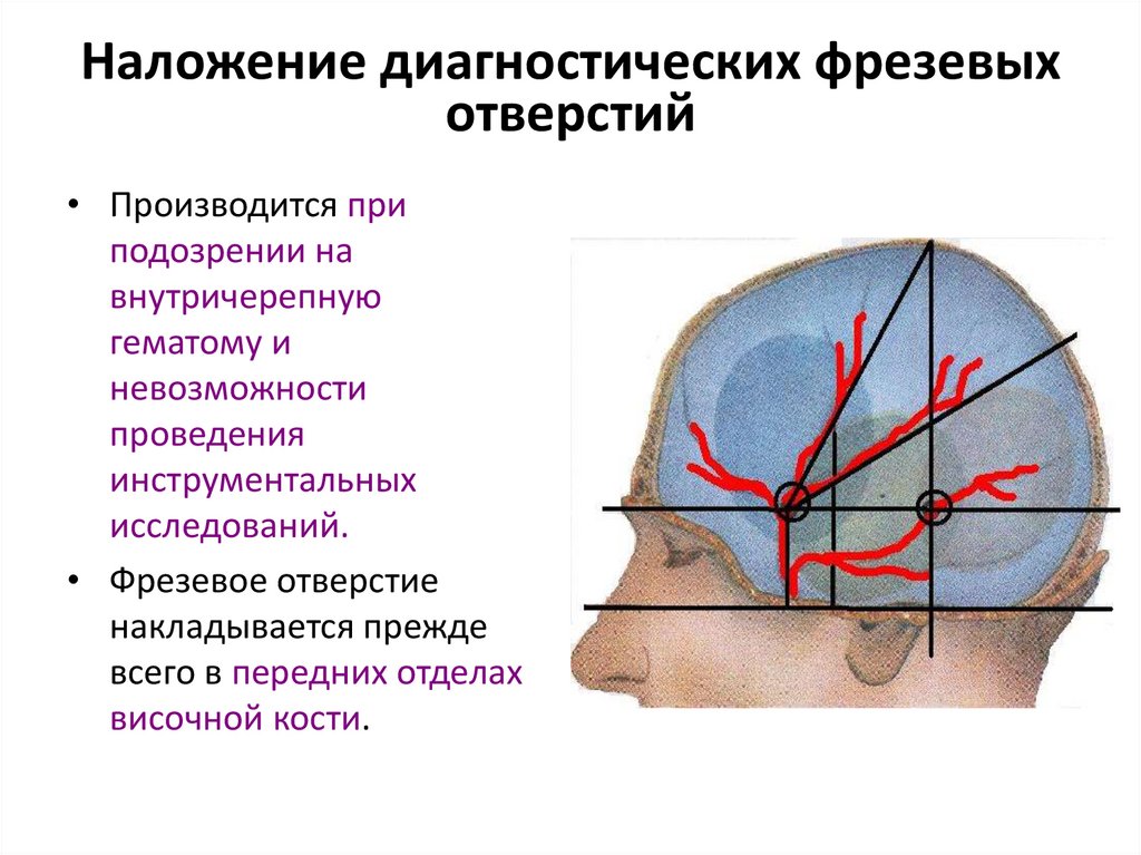 Наложение диагностических фрезевых отверстий