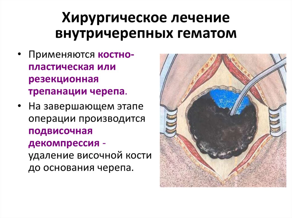 Хирургическое лечение внутричерепных гематом