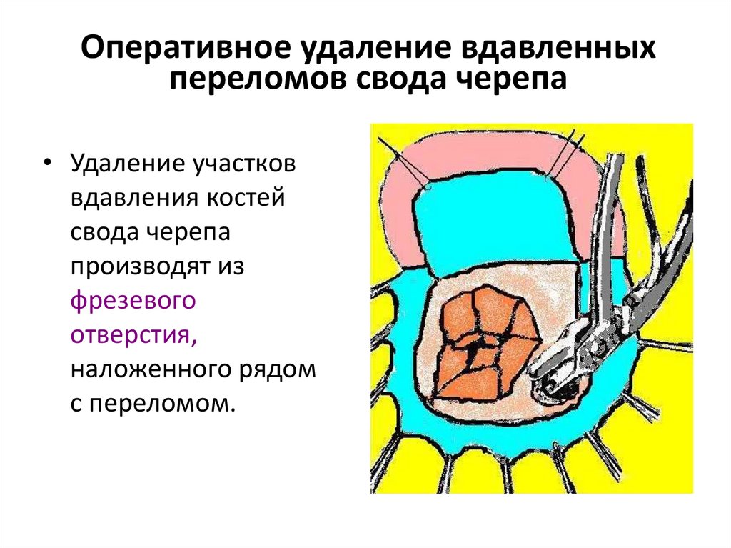 Оперативное удаление вдавленных переломов свода черепа
