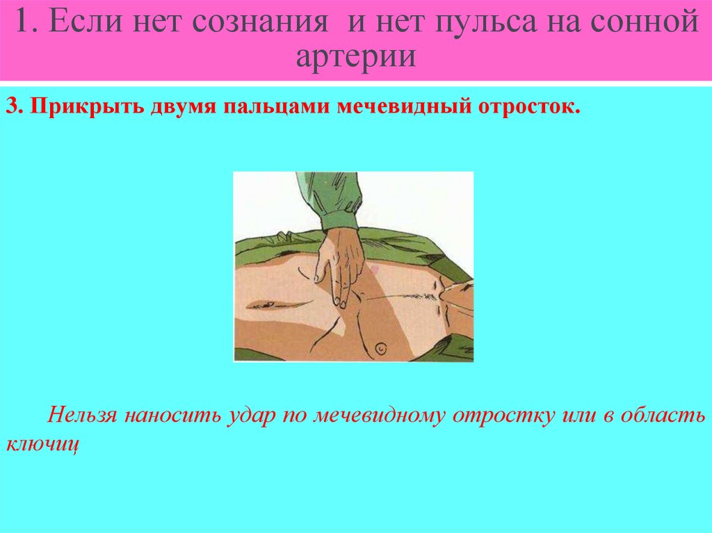 1. Если нет сознания и нет пульса на сонной артерии