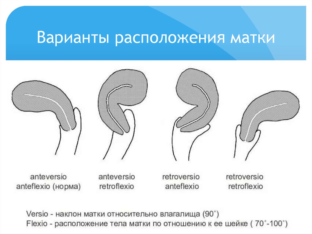 Варианты расположения матки